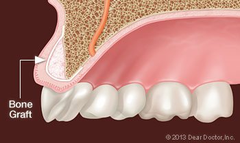 Bone grafting