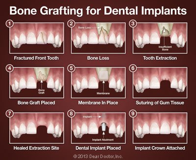 Bone grafting 2
