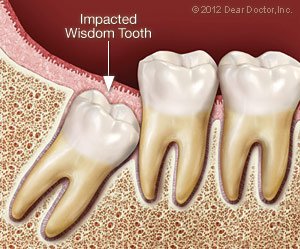 Wisdom teeth