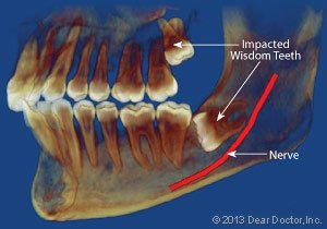 Wisdom teeth