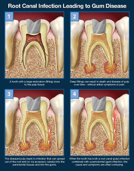 root canal
