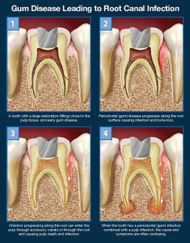 root canal 2