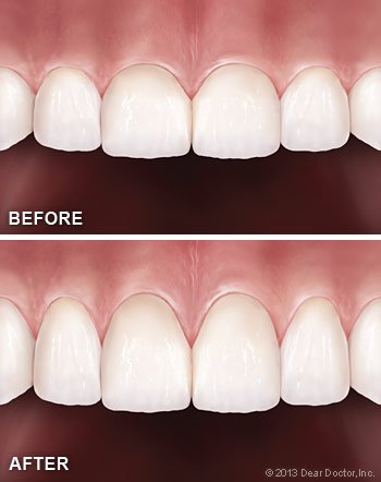 Cosmetic gum