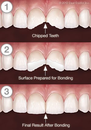 Cracked teeth