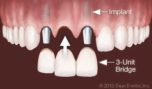 Dental Implants 2