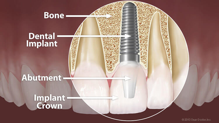 Dental Implants 2