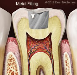 Filling 3