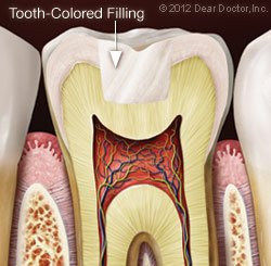 Fillings 5