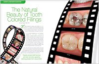 Fillings 6