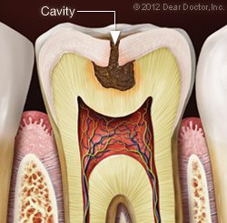 Fillings