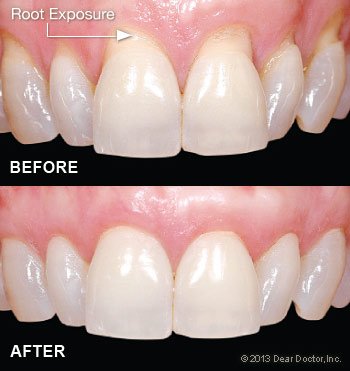 Gum grafting