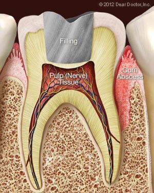 Gum Injuries