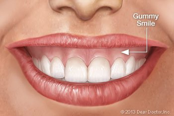 Gummy Smiles