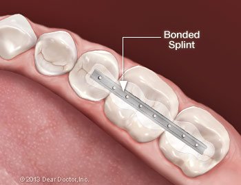 Loose tooth