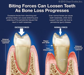 Loose tooth