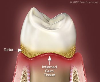 periodontal treatment