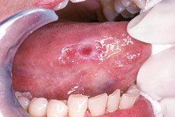 Oral cancer