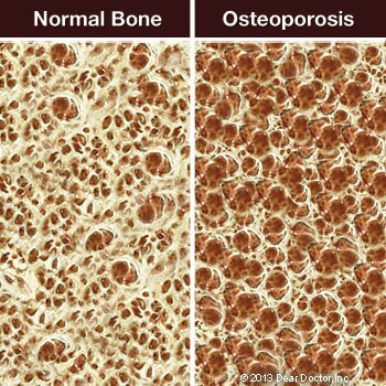 Osteoporosis