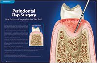 Periodontal flap 3