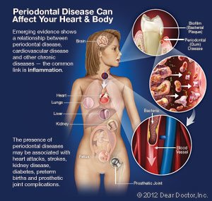Gum disease 2