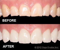 Veneers 2