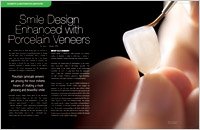 Veneers 3