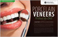 Veneers 5