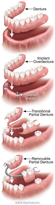 Dentures 2