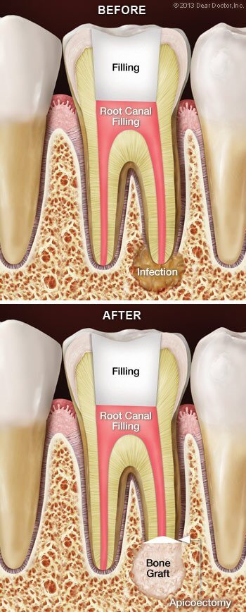 Root canal