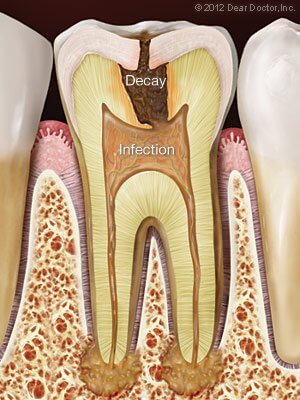 Root canal 2