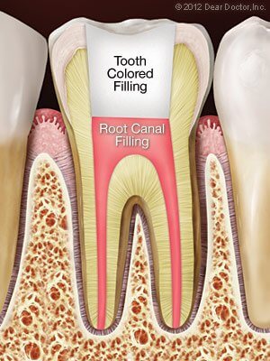 Root canal 3