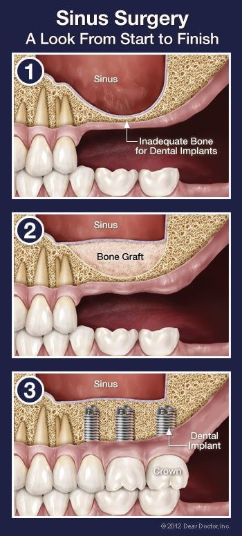 sinus surgery