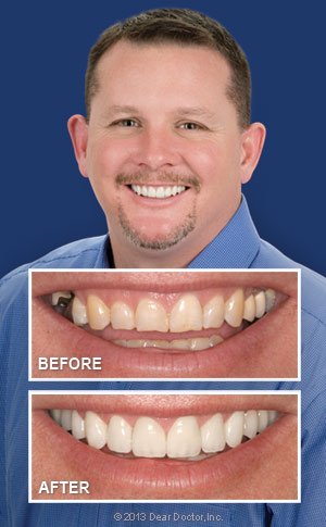 Smile makeover