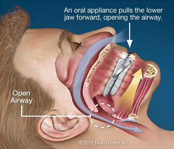 Sleep Apnea 4