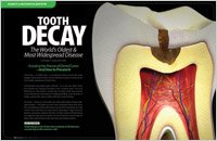 prevent cavities