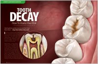 prevent cavities