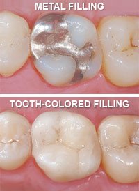 Fillings