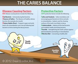 tooth decay 2