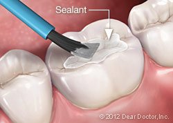 tooth decay 3