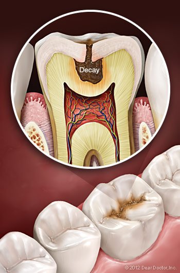 tooth decay