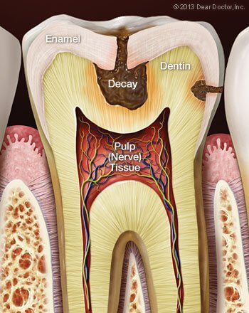 Tooth Sensitivity