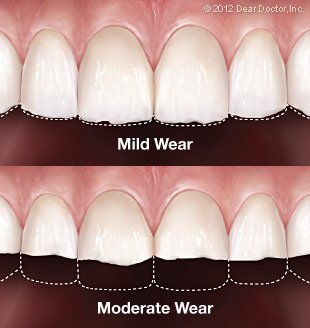 Tooth Wear