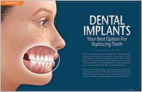 dental implants 1