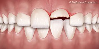 dental injuries 2