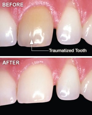 whitening