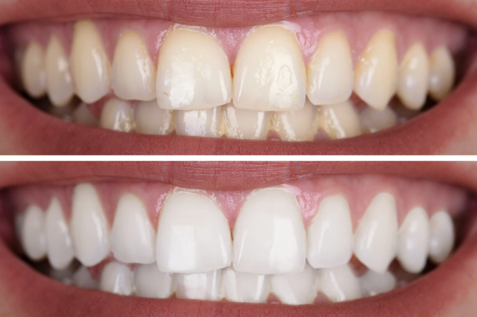 teeth whitening in San Antonio, tx