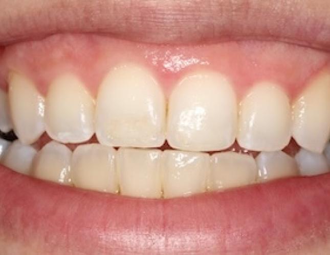 Crown lengthening after
