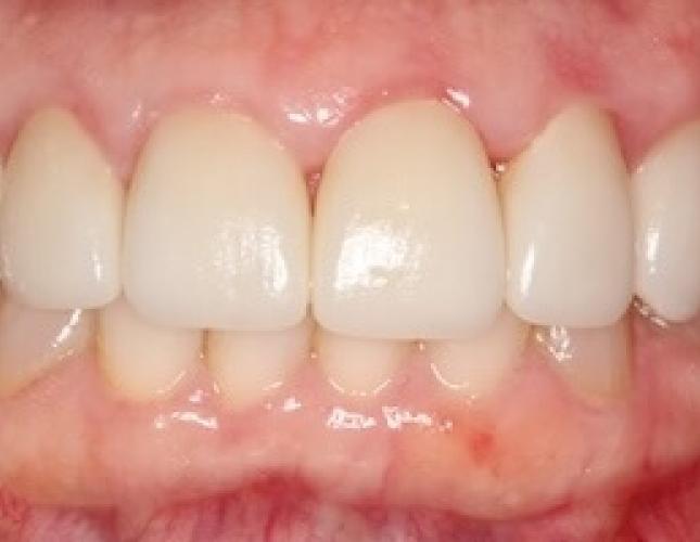 Whitening 2 after