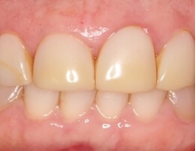 Whitening 2 before