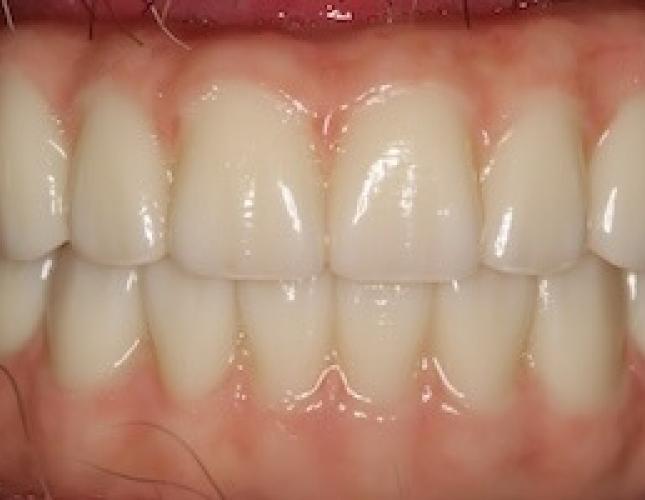 Whitening after